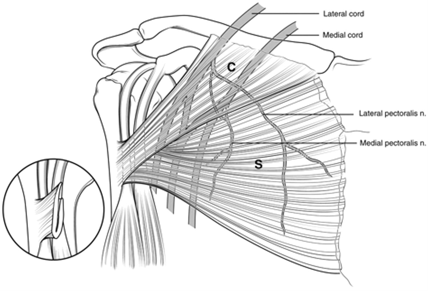 Brachial Plexus Pectoralis Minor